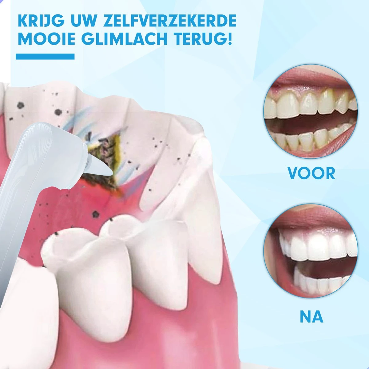 DEN-T® PRO P350 Elektrische Tandenpolijster - Wit - 5 Standen - 5 Opzetstukken - Polijstmachine - Polijstset - Tanden Polijsten - 7 DEN-T® PRO P350 Elektrische Tandenpolijster - Wit - 5 Standen - 5 Opzetstukken - Polijstmachine - Polijstset - Tanden Polijsten - - Afbeelding 5