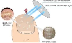 Anti Schimmelnagel Kalknagel Laserapparaat Om Zelf Te Behandelen, Veilig, Effectief, Snel En Pijnloos, Koude Laser Behandeling Voor Thuisgebruik, Voor Tenen En Vingers. Oplaadbaar. 11 Anti Schimmelnagel Kalknagel Laserapparaat Om Zelf Te Behandelen, Veilig, Effectief, Snel En Pijnloos, Koude Laser Behandeling Voor Thuisgebruik, Voor Tenen En Vingers. Oplaadbaar. -Cosmetica Winkel 1200x727